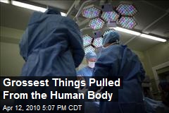 Grossest Things Pulled From the Human Body